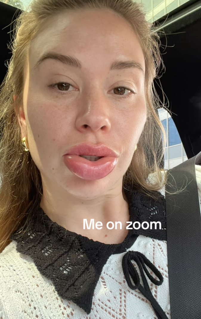 Gabby after getting her filler dissolved! 